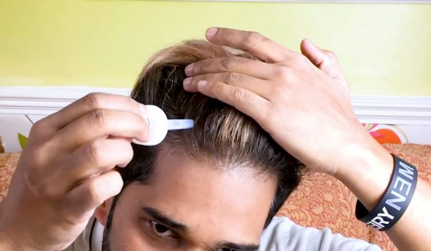 Minoxidil Nedir? Saç Dökülmesini Önler mi? Nasıl Kullanmalı? Yan Etkileri Neler?