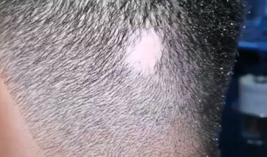 Saçkıran Sarımsak Tedavisi Nasıl Yapılır? En İyi Saç Kıran Tedavisi